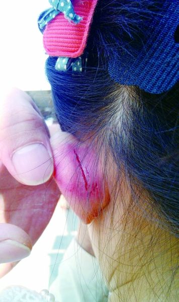 　　女童的耳朵被老師揪裂。圖片由女童家人提供