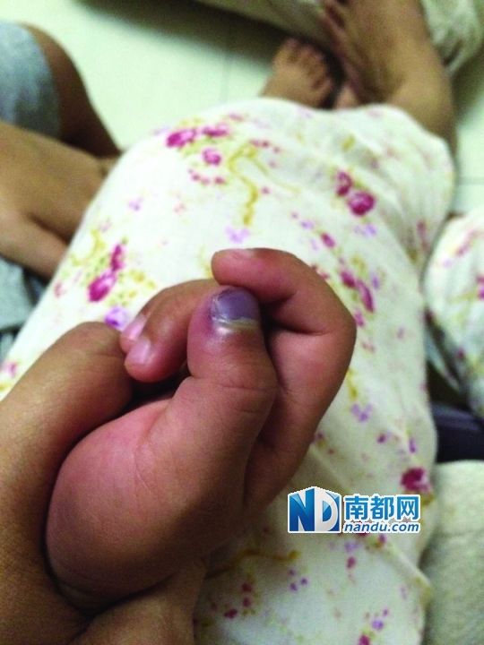 小逸手指被夾傷。