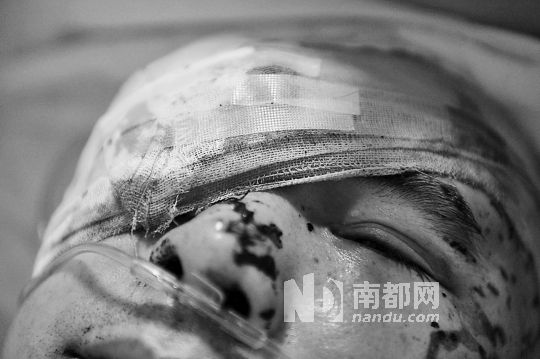 李建新頭部還有被潑硫酸的痕跡，醫生說被砍傷的右眼已經失明。 南都記者 田飛 攝