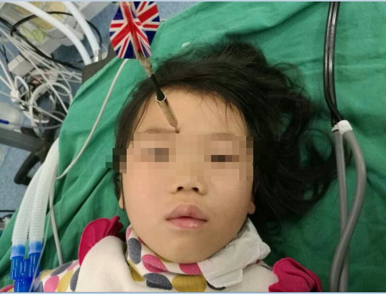 十多公分長的飛鏢穩(wěn)穩(wěn)地 ” 定 ” 在了一名六歲半的女童額頭上，小青一家人凌晨從長順趕到貴醫(yī)附院急診室時(shí)，看到如此慘烈的情況，接診醫(yī)生都嚇了一跳。詳細(xì)詢問下得知，原來是七歲的哥哥和六歲半的表妹在玩耍時(shí)，哥哥不慎將路邊撿來的真飛鏢扎到了妹妹的額頭上。