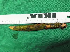 插入男子腦內的樹枝。